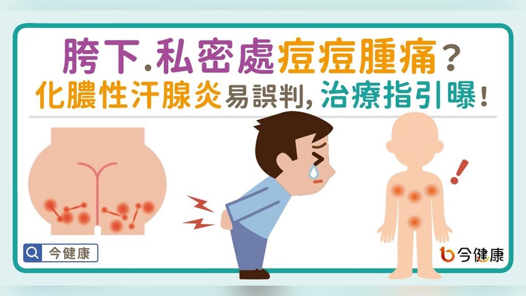 胯下、私密處痘痘腫痛？化膿性汗腺炎易誤判，治療指引曝！