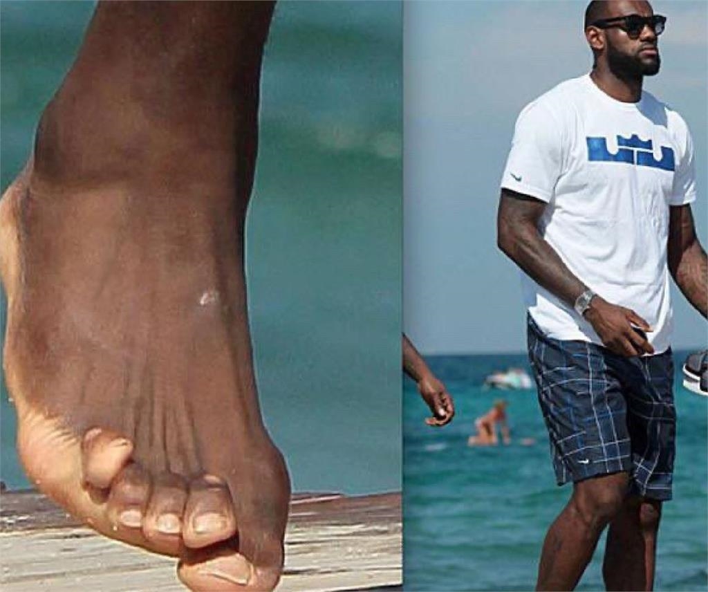 快新聞／詹姆斯「腳趾變形照」流出曝辛酸　醫師：每月得花21.9萬矯正治療