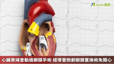 心臟衰竭曾動過瓣膜手術 經導管微創瓣膜置換術免開心