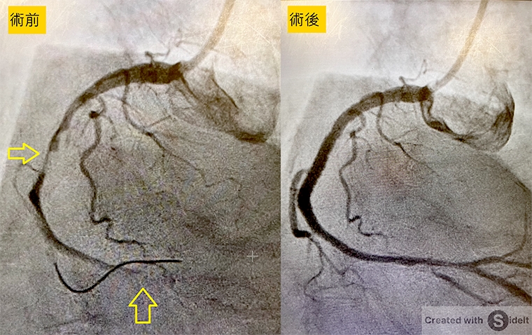 7旬翁有三高、菸齡超過40年 心梗急發作送醫搶回一命