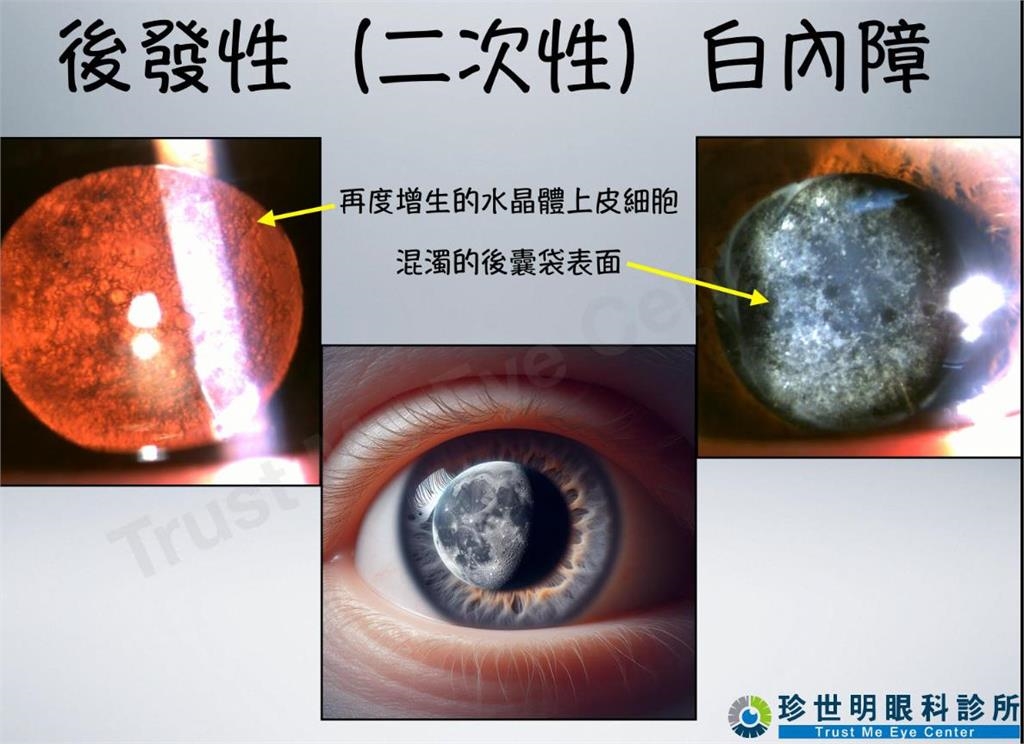 白內障術後視力又模糊!再換人工水晶體?醫:「1治療」立刻變清晰