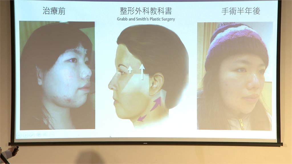 高筋膜拉皮精密顏面手術 助「草莓女孩」重展笑顏