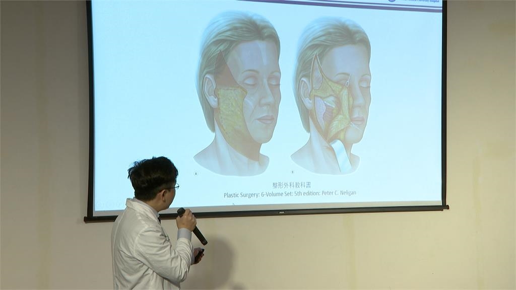 高筋膜拉皮精密顏面手術 助「草莓女孩」重展笑顏