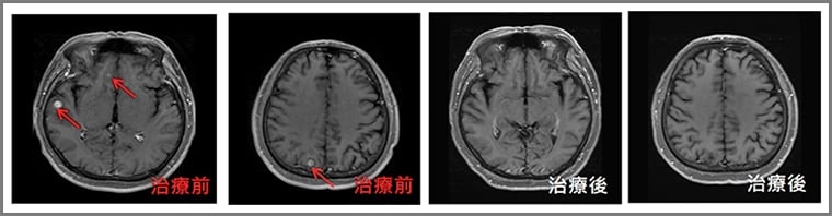 37歲吸菸男頭痛竟是肺癌腦轉移 接受1治療減少腦傷害