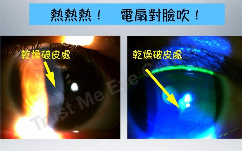 小電扇狂吹臉?有人吹到角膜破皮 醫:淚水蒸發小心「乾眼症」