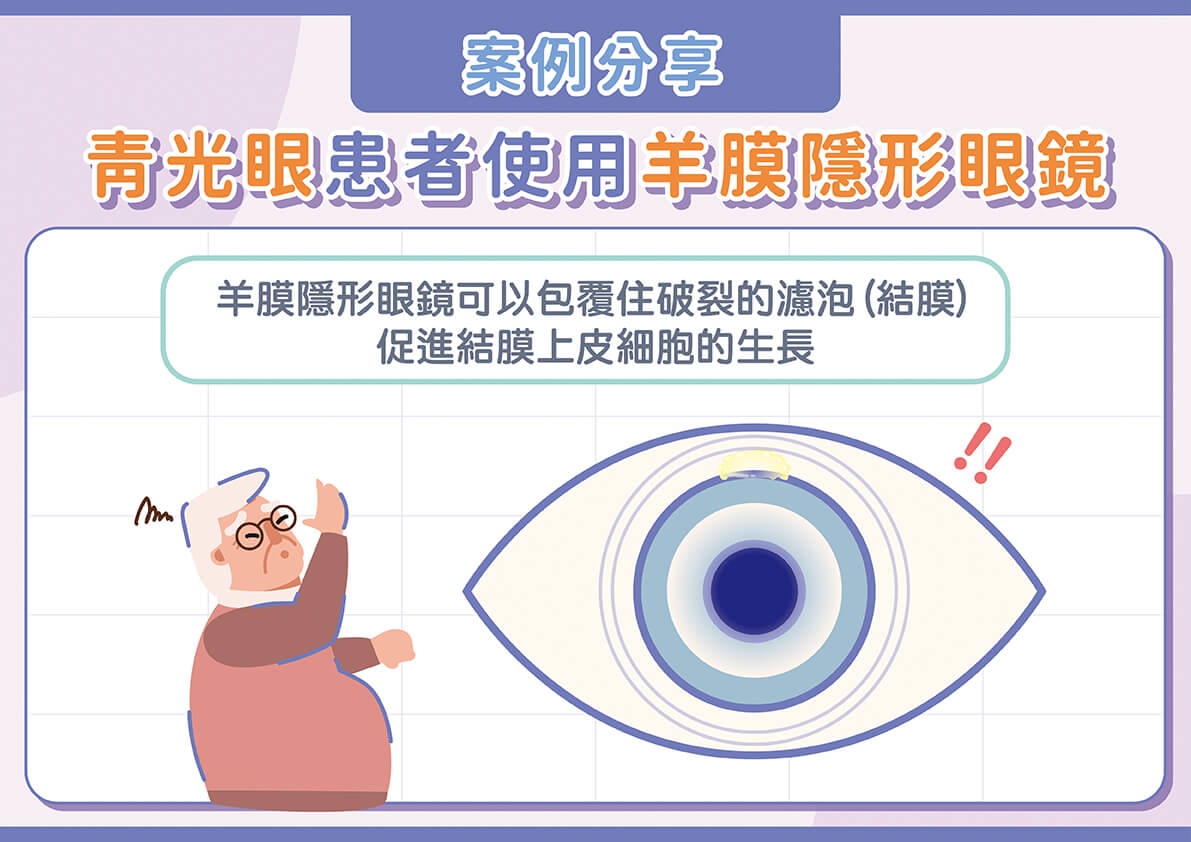 現代3C族必看！忽視乾眼症當心三大併發症找上！