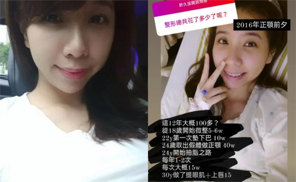 台灣最頂女優「10年臉蛋進化史」!砸百萬動刀「18歲就微整」網震撼:值得…