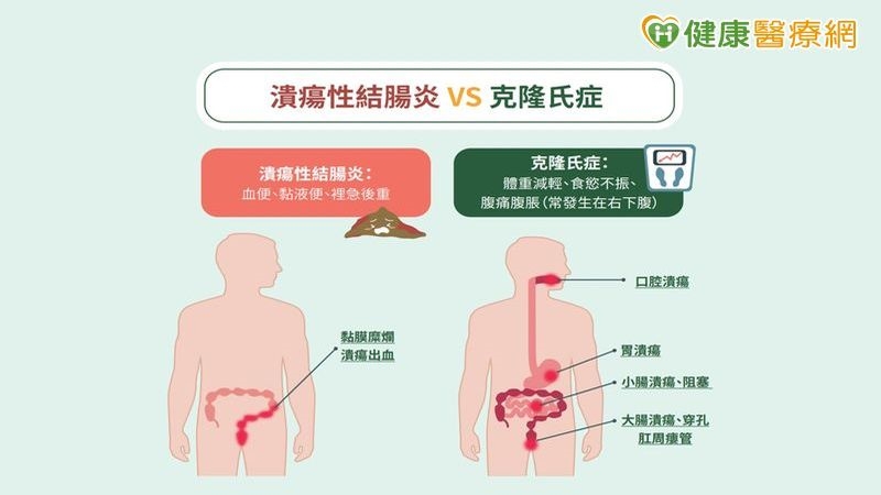 青壯年IBD病痛難以言喻!政策與治療為生活帶來新契機