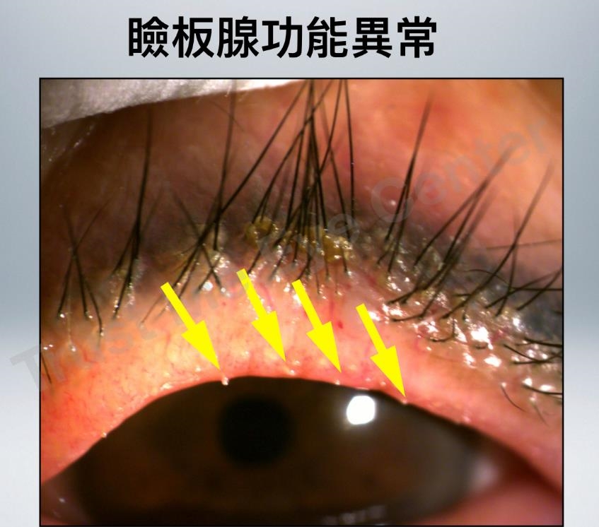 眼睛乾澀、異物感別輕忽！小心「瞼板腺阻塞」　專家教你護眼大作戰