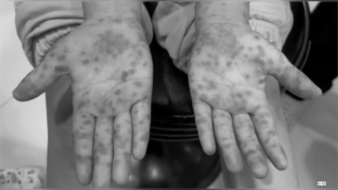 腸病毒肆虐不可輕忽！　　五歲女童雙手長密密麻麻水泡、紅疹