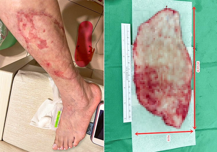 車禍後左腿皮膚掀起!醫師「神操作」讓女子重拾美腿