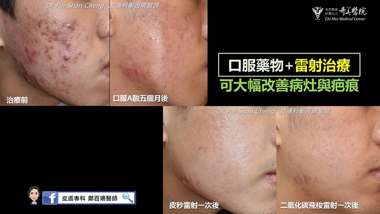 青春痘長大就會好?男大生聽信長輩建言 滿臉痤瘡痘疤