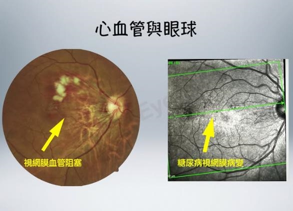 自覺健康卻暗藏危機！男子驗出「視網膜病變」　不知自己已患糖尿病