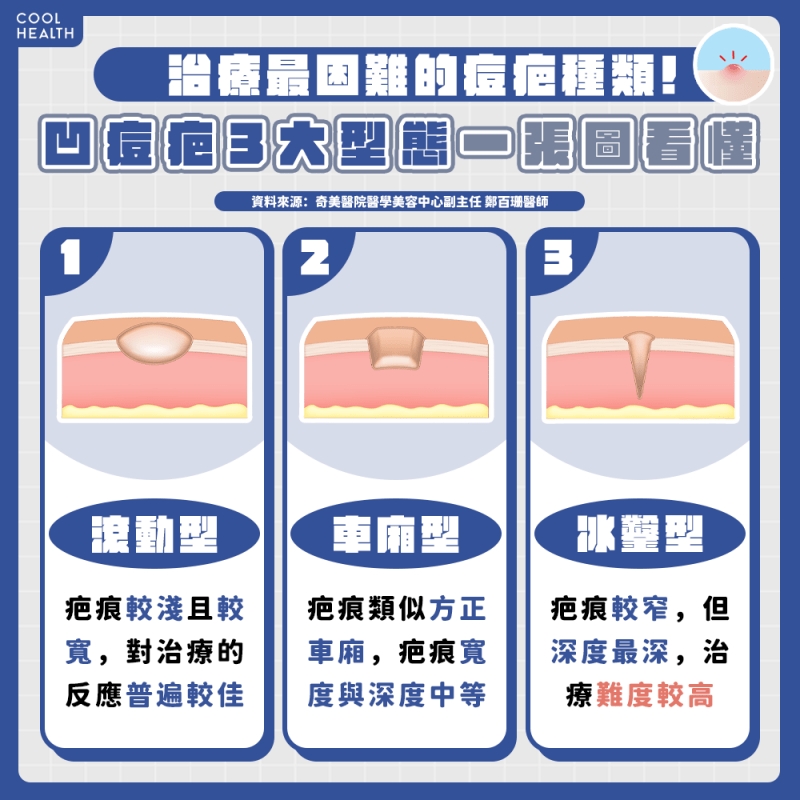 A酸與雷射治療不能一起使用? 醫澄清:併用對消痘疤效果更佳
