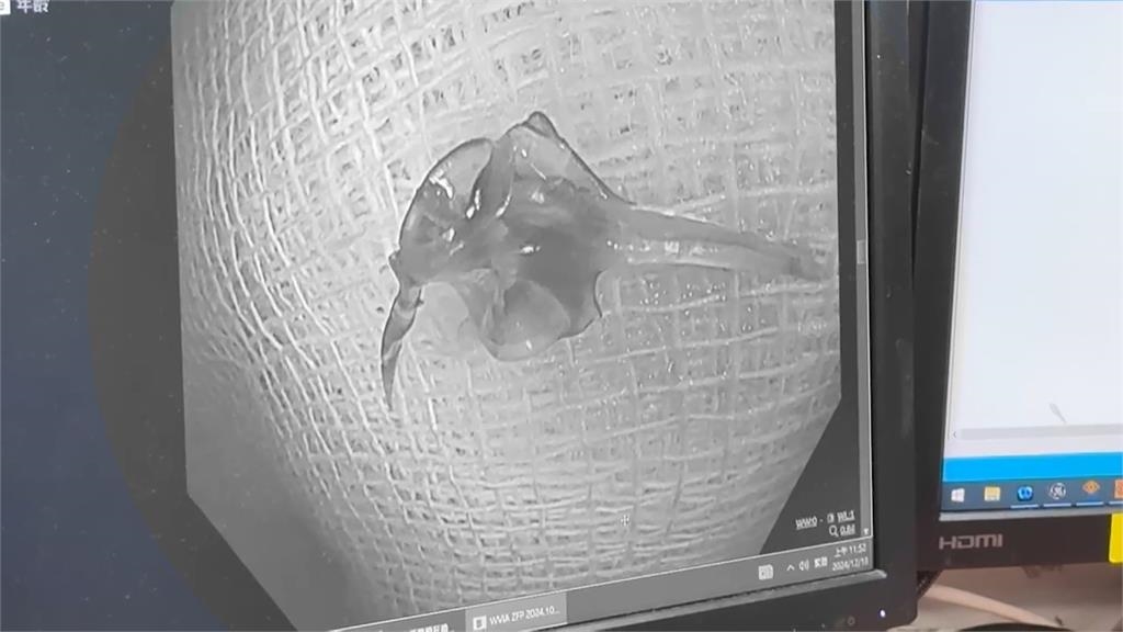 基隆80歲翁誤食魚骨掛急診 大腸積滿「鮮血、黑便」