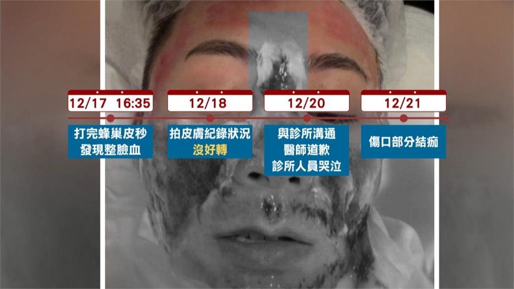 男回台打蜂巢皮秒「整臉血」行程全泡湯 醫美診所:他求償300萬