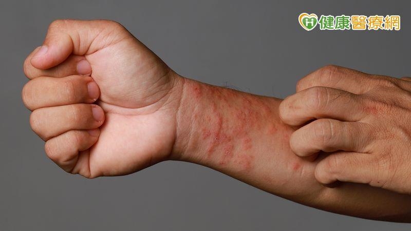 皮膚透露的免疫警訊！　醫教你改善易被忽視的異位性皮膚炎與圓禿