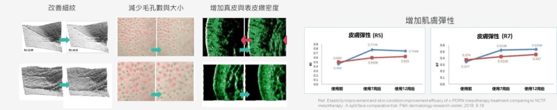 韓國醫美大勢爆品「麗珠蘭」登台！該選手打、機打還是塗抹？醫師這樣說