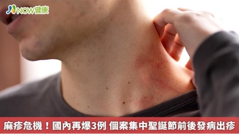 麻疹危機！國內再爆3例 個案集中聖誕節前後發病出疹