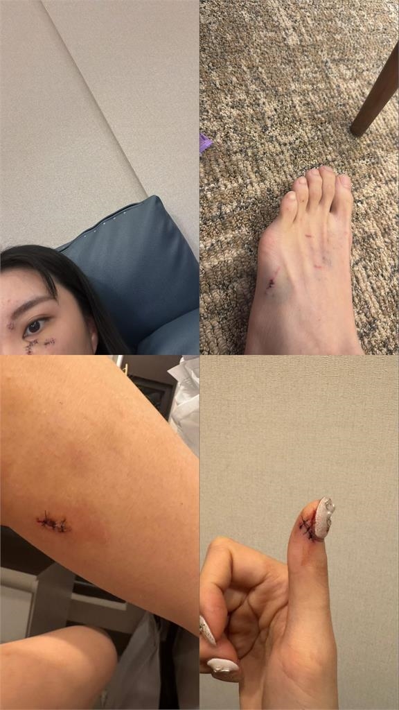 孫生前女友出事了!浴室玻璃門突爆裂「割傷濺血」急送醫 最新傷勢曝光