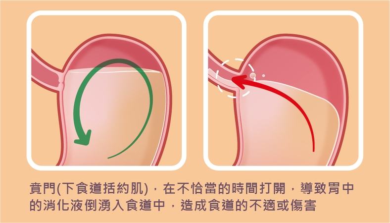 胃食道逆流怎麼辦?胃藥怎麼吃?