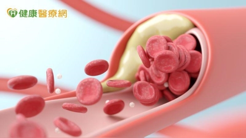 血管嚴重鈣化治療風險高! 「最新治療」用震的疏通血管,減少損傷
