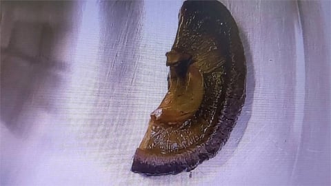 進食未咬碎！　男子腸阻塞開刀取出「5公分大香菇」