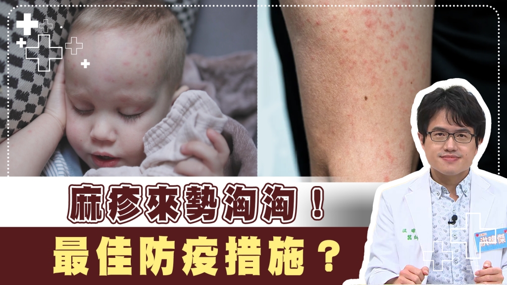 麻疹未發病前4天就有傳染性！　避免重症「這方法」達90%保護力！　