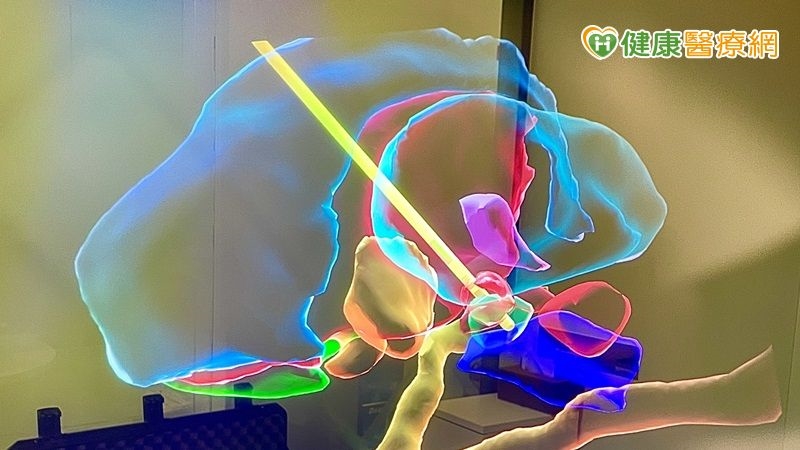 AI導引加持！　北榮影像程控深層腦部刺激術 助動作障礙患者重啟人生