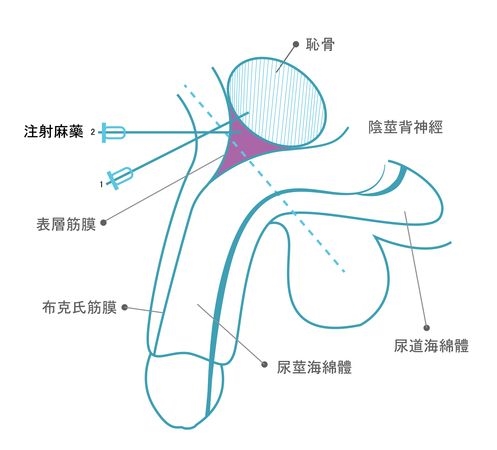 孩子割包皮麻醉醒後感到痛？　「１治療法」解決疼痛、成功完成手術