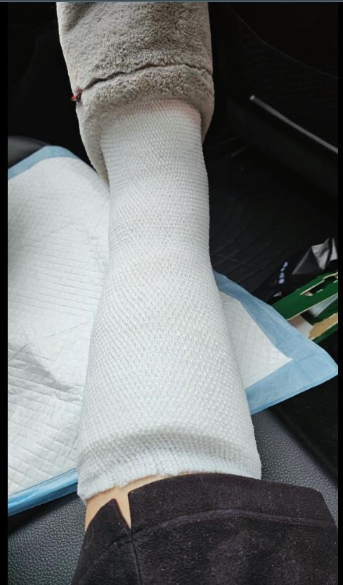 美魔女陳美鳳「買花慘摔」畫面流出!本尊曝「打石膏傷勢照」認做錯1事