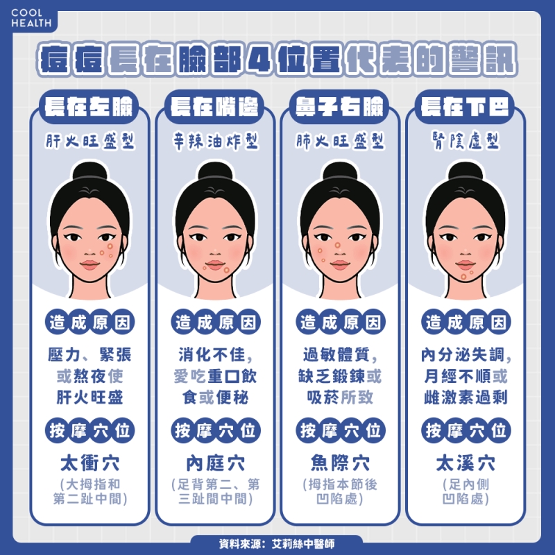 痘痘常固定長在同一位置? 中醫師建議:多按摩「4大穴位」