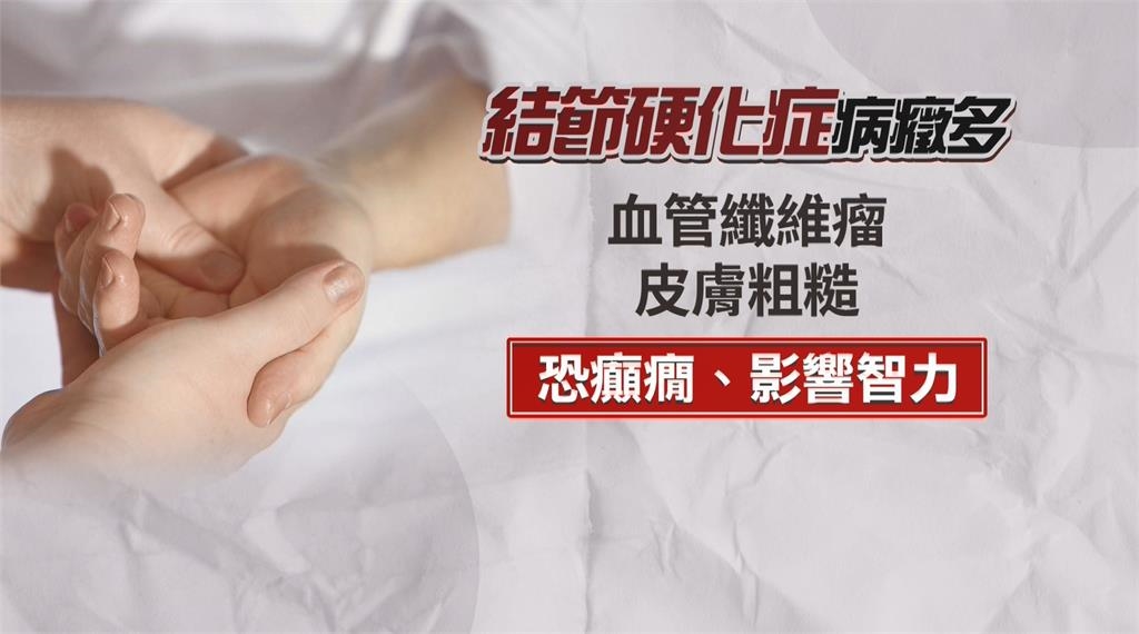 6歲童罹罕病「苦等一個家」 主治醫師親自收養