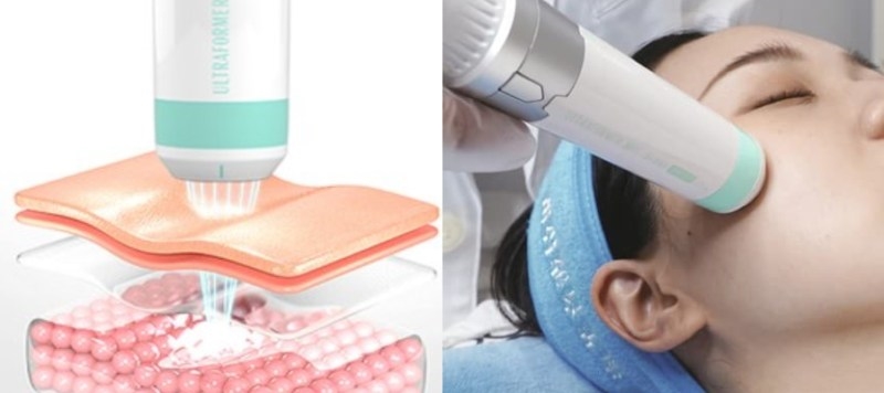 「冰晶水光」——低溫冷凍技術，無痛直送肌底