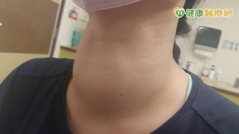 雙十年華卻出現「大脖子」 原來是這1疾病惹的禍!