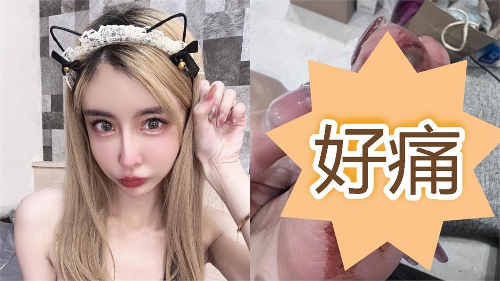 雪碧出事送急診「鐵片削兩塊肉」傷勢曝!2個月前才慘摔「肋骨插內臟」痛哭 雪碧出事送急診「鐵片削兩塊肉」傷勢曝!2個月前才慘摔「肋骨插內臟」痛哭