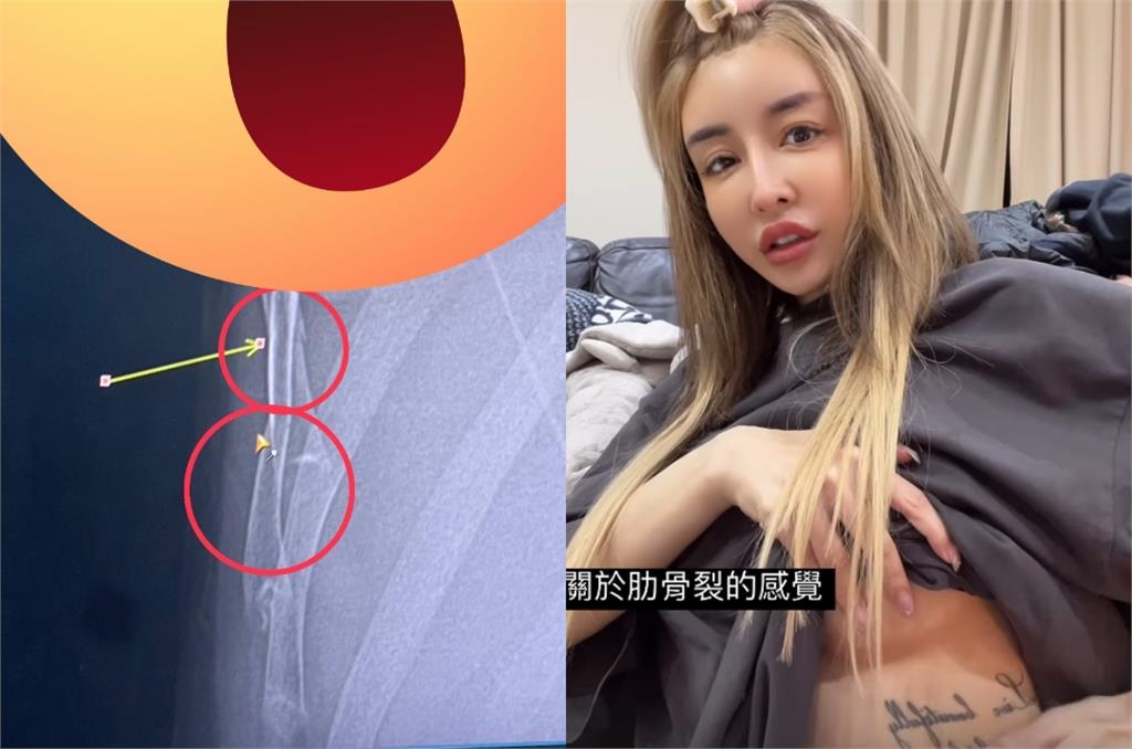 雪碧出事送急診「鐵片削兩塊肉」傷勢曝!2個月前才慘摔「肋骨插內臟」痛哭