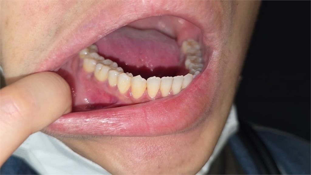 知名隱形牙套「綻雅」戴出狀況? 受害人投訴:口腔白斑、牙齦萎縮