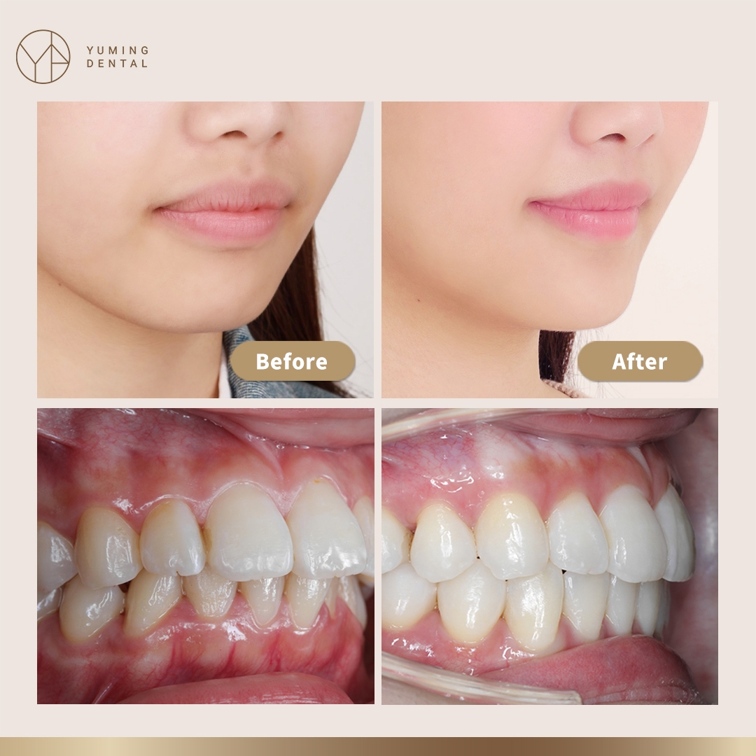 一年之計在於春!提升自我形象 從「齒」矯正悄悄變美