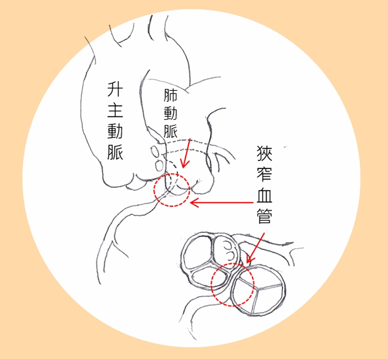 右冠狀動脈出口狹窄嚴重恐致命! 繞道手術除「心」患