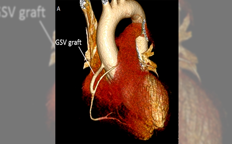 右冠狀動脈出口狹窄嚴重恐致命! 繞道手術除「心」患