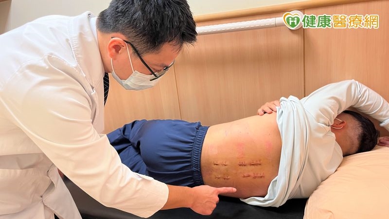 從高處墜落致「屈曲牽張性骨折」 微創手術助快速康復