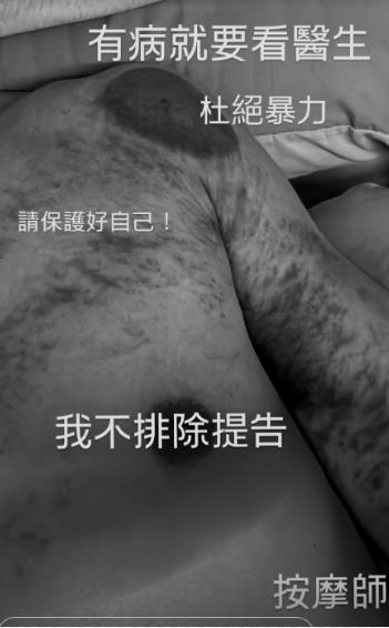 吳婉君「前夫」現身了！裸上身公開「公開傷痕照」砲這句疑偷臭趙駿亞