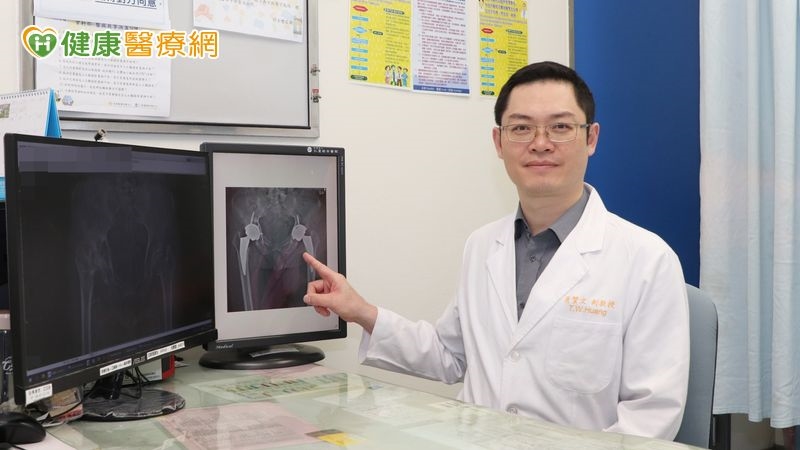 髖關節疼痛以為拉傷竟需置換關節 「1手術」助迅速重返職場與運動