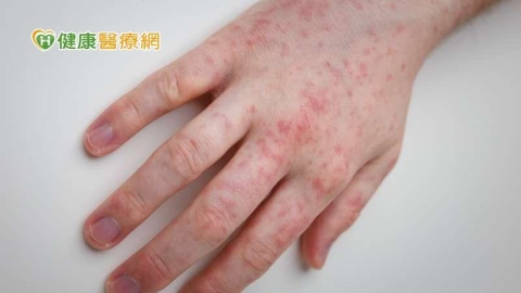 國內麻疹病例+3!國外疫情也相當嚴峻 今年美國麻疹病例數已是去年2倍