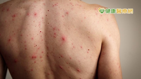 國內又見麻疹群聚案件! 國際疫情嚴峻「旅遊警示」升級共7國列第2級