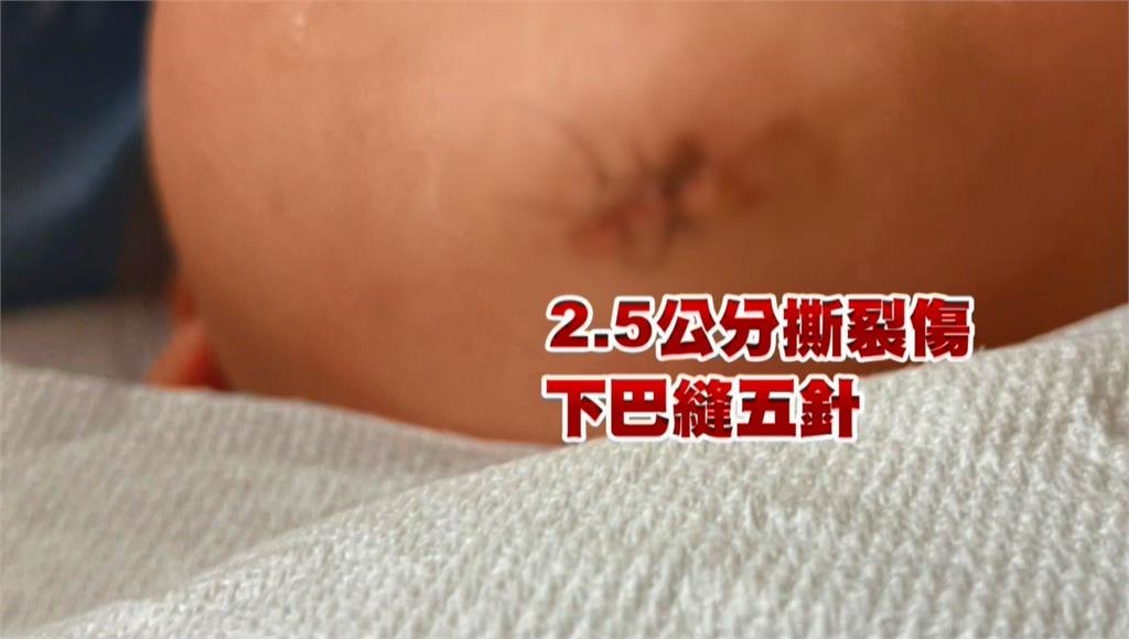 4歲童看牙科從椅子重摔下巴縫5針 家長控院方處理消極