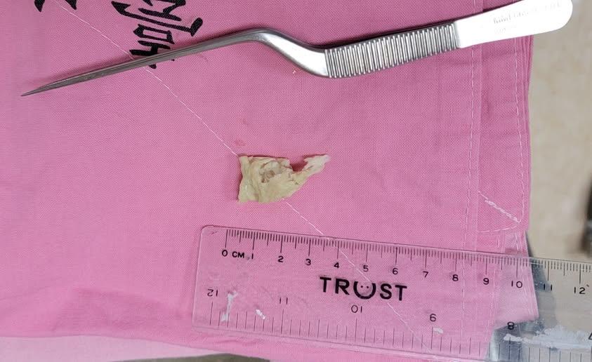 70歲伯感冒鼻塞狂吸不通!醫一吸竟拖出「恐怖異物」本人都傻眼