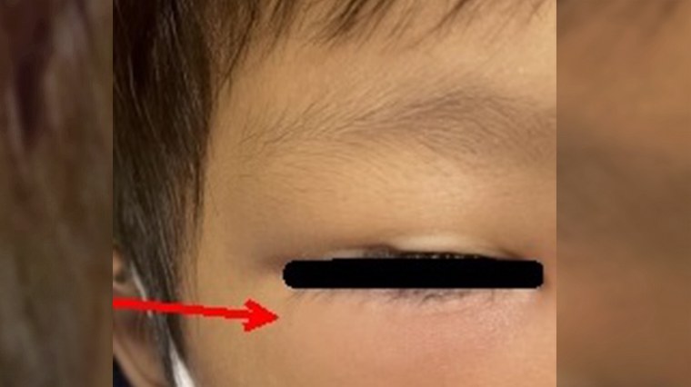 感冒鼻塞竟引發蜂窩性組織炎 眼瞼紅腫、疼痛愛注意!