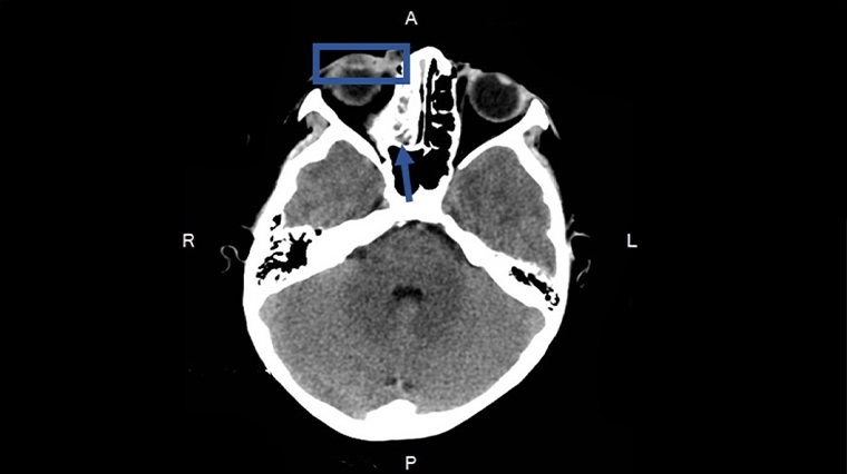 感冒鼻塞竟引發蜂窩性組織炎 眼瞼紅腫、疼痛愛注意!